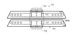 MRI-Safe Implant Magnet with Angular Magnetization