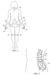 Methods and compositions for treating post-operative pain comprising clonidine