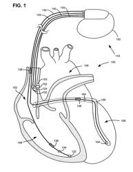 Method and implantable system for blood-glucose concentration monitoring using parallel methodologies