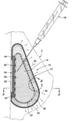 Inflatable prostheses and methods of making same