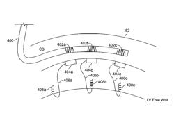 Cardiac stimulation using leadless electrode assemblies