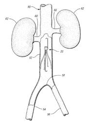 VENA CAVA FILTER WITH DUAL RETRIEVAL