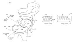 Locking assembly for tibial prosthesis component