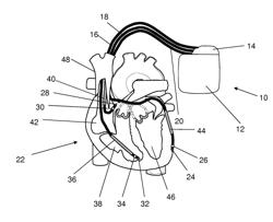 Heart stimulator and method for A-V delay optimization