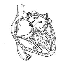 PERCUTANEOUS CATHETER DIRECTED INTRAVASCULAR OCCLUSION DEVICE