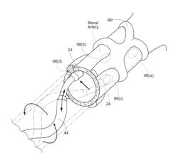 Multi-directional deflectable catheter apparatuses, systems, and methods for renal neuromodulation