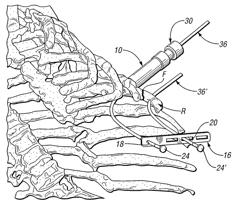 Bone repair system and method