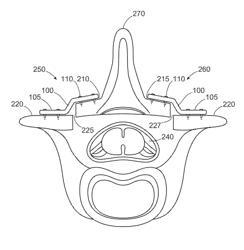 LAMINOPLASTY SYSTEM