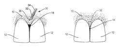 Expansion device for treatment of black triangle disease and method