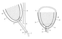 Endoscopic heart surgery method