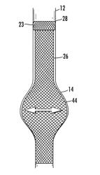 Stent/stent graft for reinforcement of vascular abnormalities and associated method