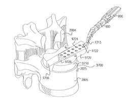 Spinal implant system