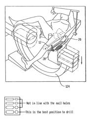 DISTAL TARGETING DEVICE