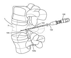 DEVICE TO AID IN THE DEPLOYMENT OF A SHAPE MEMORY INSTRUMENT