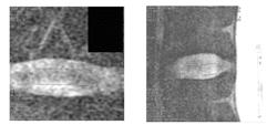 MR spectroscopy system and method for diagnosing painful and non-painful intervertebral discs