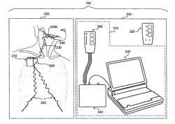 Screening Devices and Methods for Obstructive Sleep Apnea Therapy