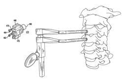 Intervertebral disc and insertion methods therefor