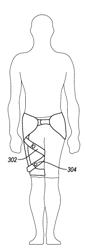 ORTHOPEDIC DEVICE FOR TREATING COMPLICATIONS OF THE HIP