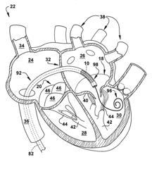 APPARATUS AND METHOD FOR REPLACING A DISEASED CARDIAC VALVE