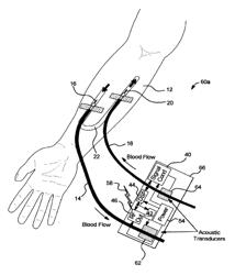 Acoustic access disconnection systems and methods