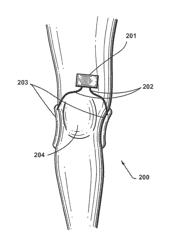 APPARATUS AND METHOD FOR ELECTROMAGNETIC TREATMENT OF NEURODEGENERATIVE CONDITIONS