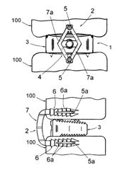 Vertebral osteosynthesis material