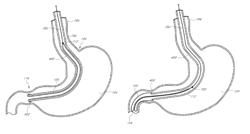 Methods for toposcopic sleeve delivery