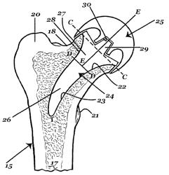 Hip joint prosthesis