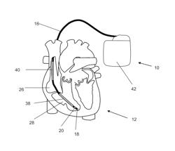 Cardioverter/defibrillator and signal processing device for classifying intracardiac signals