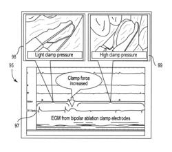 Tissue lesion evaluation