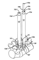 Spinal fixation element and methods