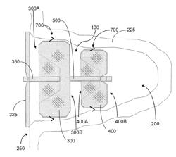 OCCLUSION DEVICE AND ASSOCIATED DEPLOYMENT METHOD