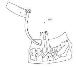 PERCUTANEOUS ROD INSERTER