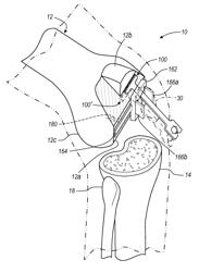 Method for less invasive knee resection