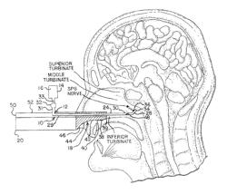 Methods for ameliorating pain and devices for delivering a medicament