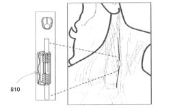 EXTREMELY LOW DUTY-CYCLE ACTIVATION OF THE CHOLINERGIC ANTI-INFLAMMATORY PATHWAY TO TREAT CHRONIC INFLAMMATION