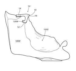 Methods and apparatus for FAI surgeries