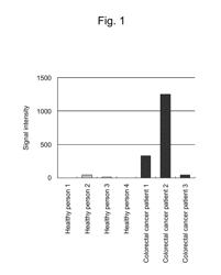 MARKER FOR DETECTING COLORECTAL CANCER OR ESOPHAGEAL CANCER AND METHOD FOR EXAMINING SUCH CANCER