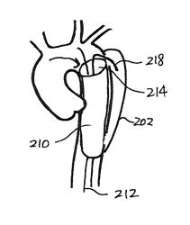 Devices, therapeutic compositions and corresponding percutaneous treatment methods for aortic dissection