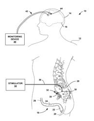 CORTICAL POTENTIAL MONITORING