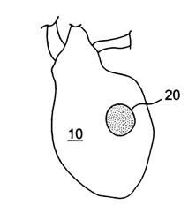 Prevention of myocardial infraction induced ventricular expansion and remodeling