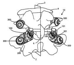 FACET JOINT REPLACEMENT INSTRUMENTS AND METHODS