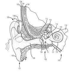 DEVICES FOR ENHANCING TRANSMISSIONS OF STIMULI IN AUDITORY PROSTHESES