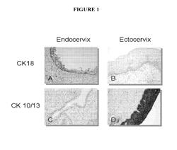 METHOD FOR DETECTING CERVICAL DYSPLASIA