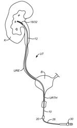 Methods and systems for capturing and removing urinary stones from body cavities