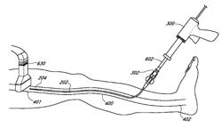 Systems for venous occlusion for the treatment of venous insufficiency