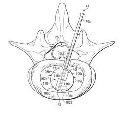 Methods of spinal nucleus replacemennt