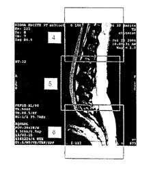 MR SPECTROSCOPY SYSTEM AND METHOD FOR DIAGNOSING PAINFUL AND NON-PAINFUL INTERVERTEBRAL DISCS