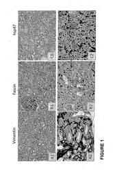 ENDOTHELIAL CELLS ACTIVATION BIOMARKERS CHARACTERIZING ANTIBODY MEDIATED REJECTION AND USES THEREOF