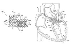 Dual valve prosthesis for transcatheter valve implantation